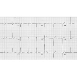 EKGs Simplified