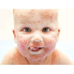 NCLEX - Pediatric Integumentary (Skin) Disorders