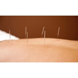 One Hour of Acupuncture and Tui Na Massage or Herbal Medicine Consultation at Center Acupuncture (Up to 72% Off)