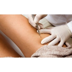 Removal of One, Two, or Three Skin Tags at Body Beautiful Spa (Up to 47% Off)