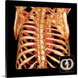 Large Gallery-Wrapped Canvas Wall Art Print 20 x 20 entitled Rib cage and heart, 3D CT scan